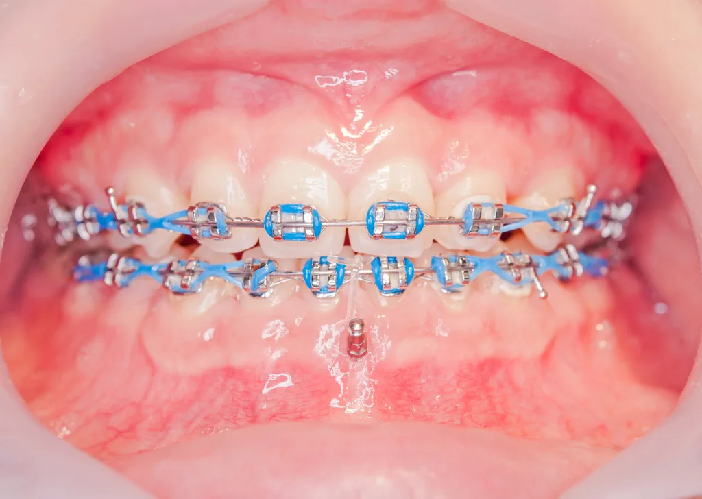 Orthodontic Mini Implants: What to Know?